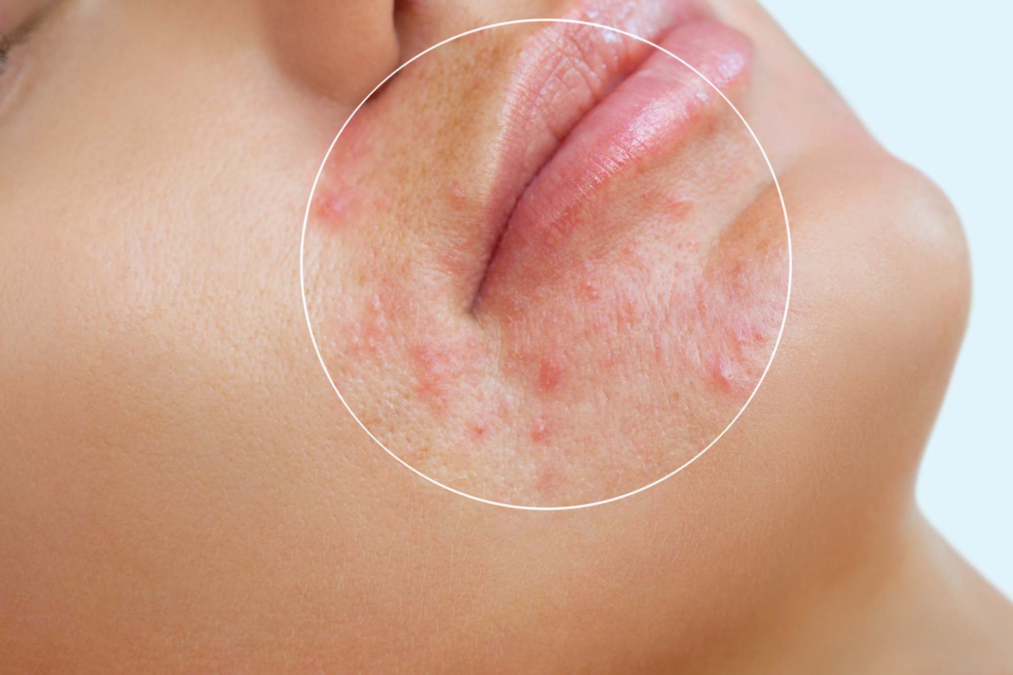A young girl with a problem skin. Photo before and after treatment for acne. Treatment of problem skin cosmetology concept. A young girl with a problem skin. Photo before and after treatment for acne. Treatment of problem skin cosmetology concept.