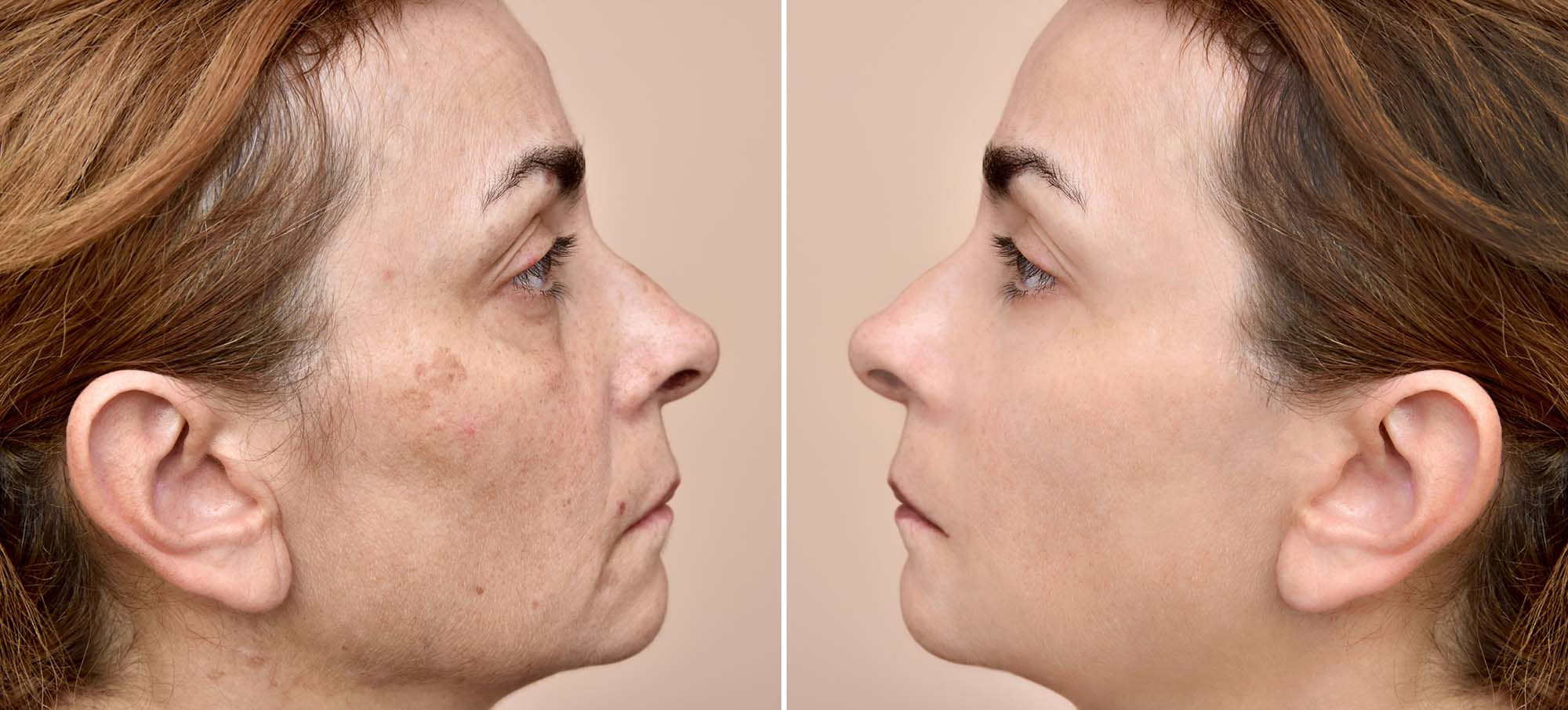 Woman before and after applying make-up and removing eye bags A set of two portraits of the same woman, one before and the other after applying make-up and removing eye bags. Beauty treatment concept.