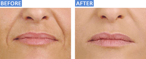 LipsBefore&After LipsBefore&After