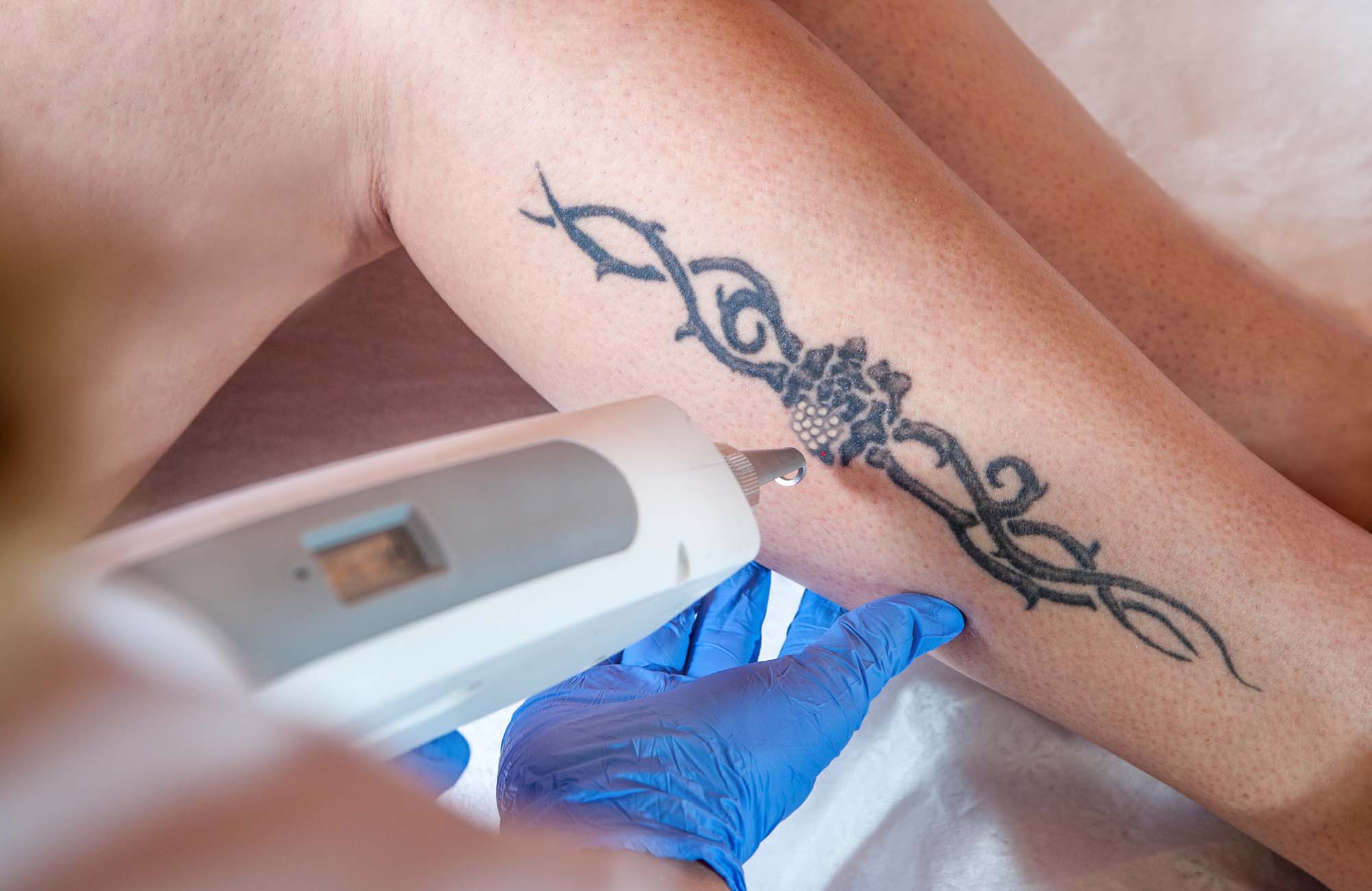 laser tattoo removal from leg