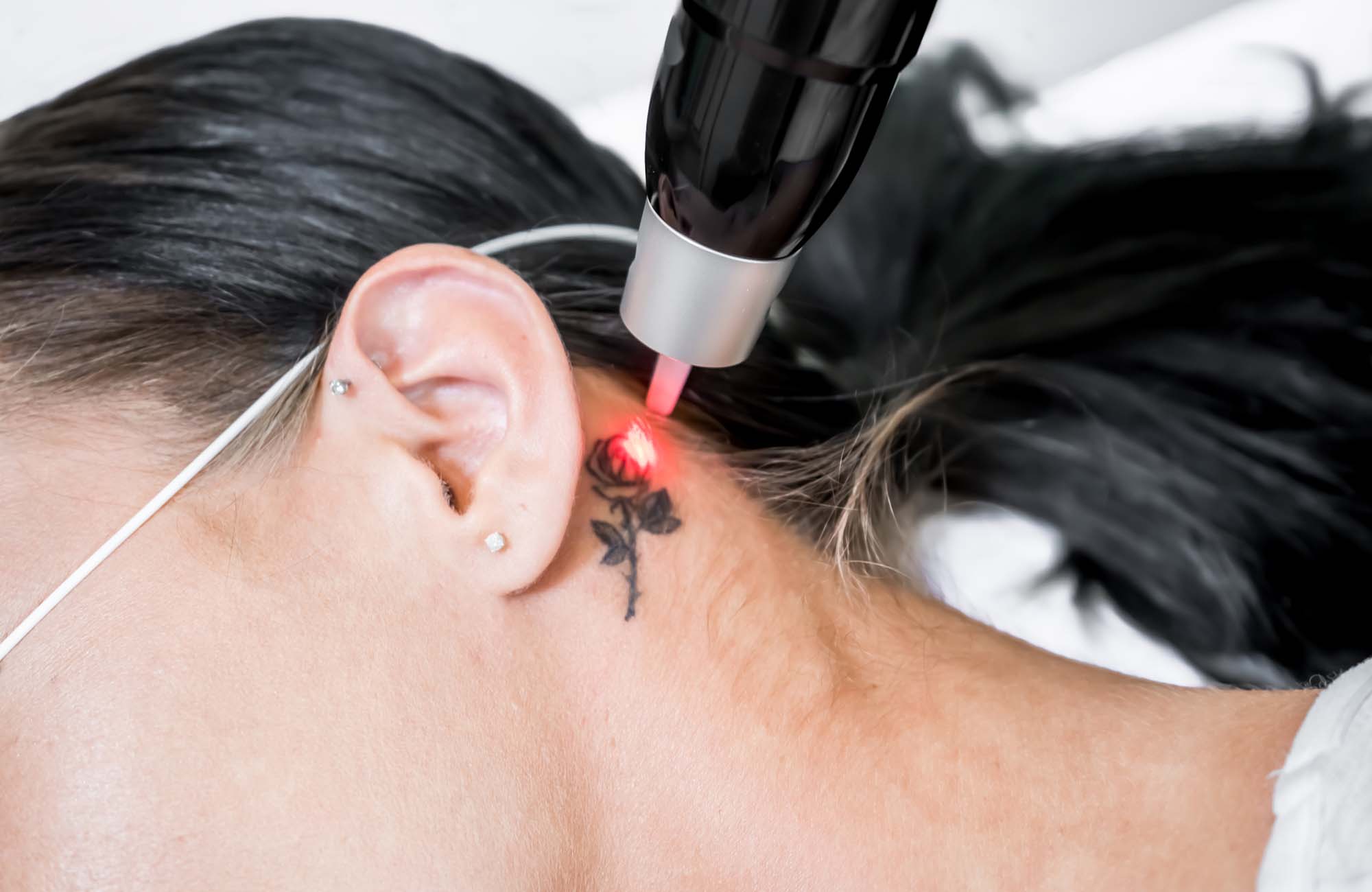 Laser tattoo removal treatment session on patient, using picosecond technology, to break down tattoo ink into smaller particles. At a beauty and skincare clinic for aesthetic lasers.