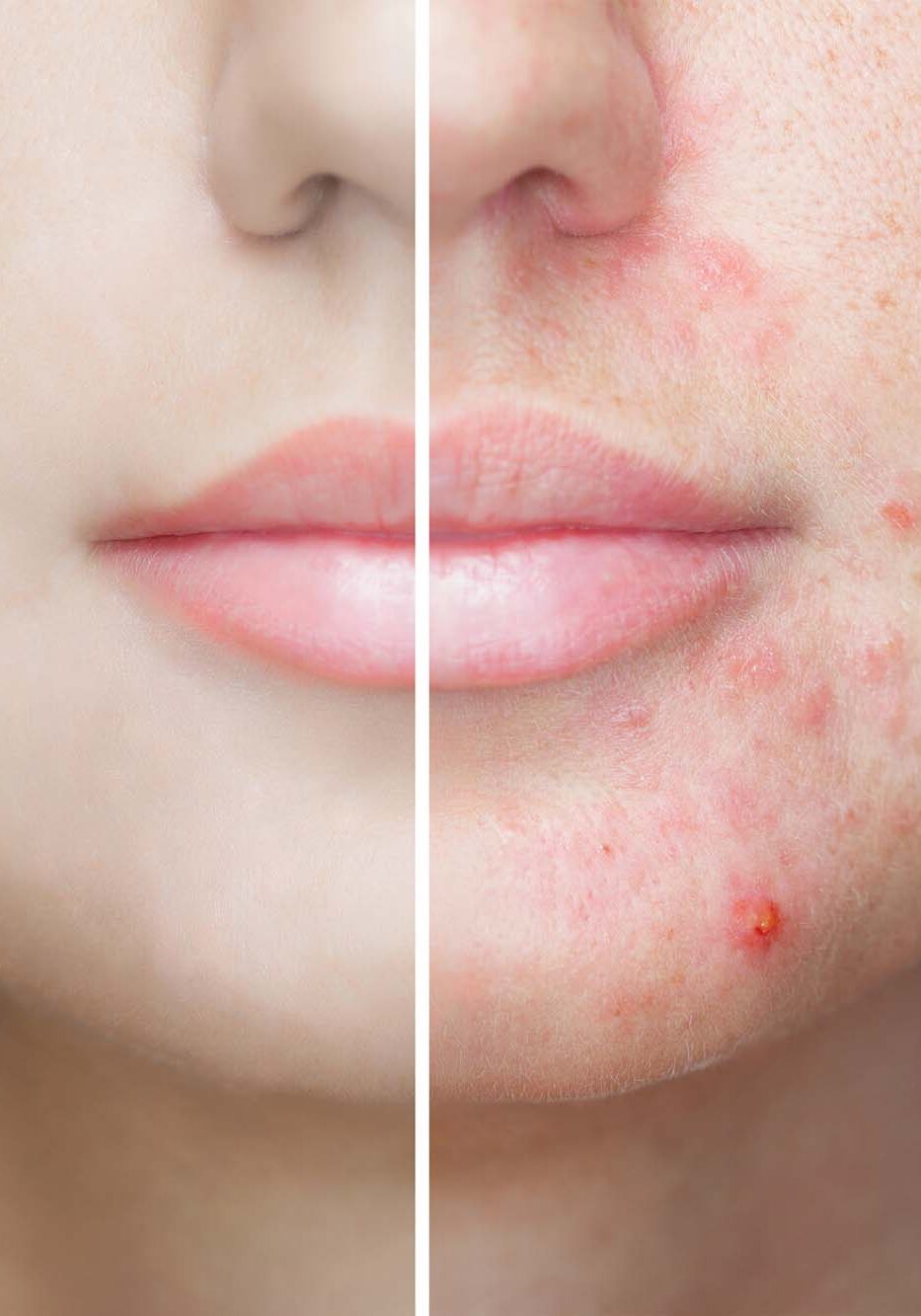 A young girl with a problem skin. Photo before and after treatment for acne. A young girl with a problem skin. Photo before and after treatment for acne.