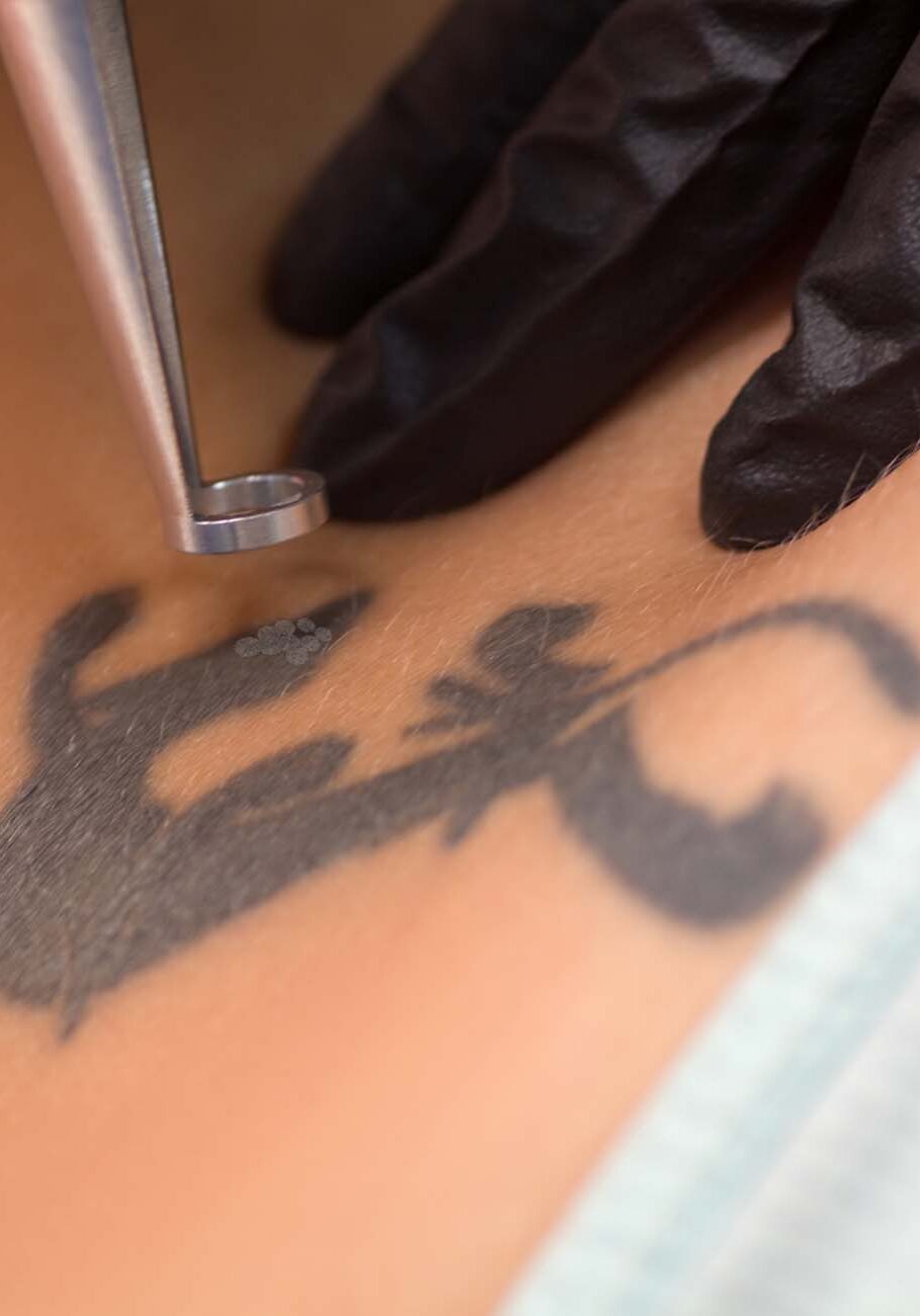 Laser tattoo removal procedure. Salon equipment Laser tattoo removal procedure. Salon equipment