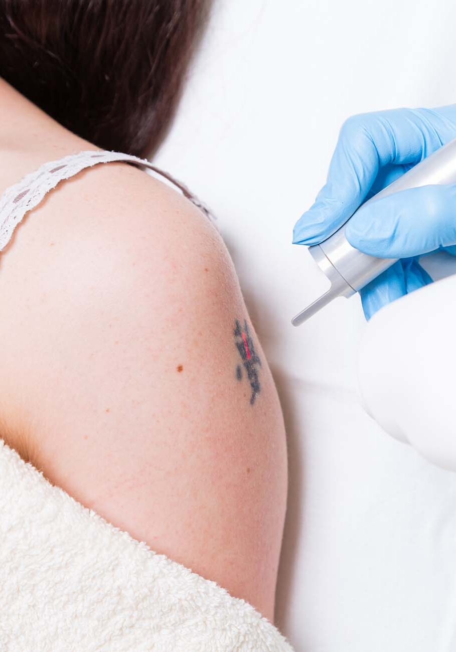 Removing tattoo Removing tattoo on arm of a young woman by medical laser.