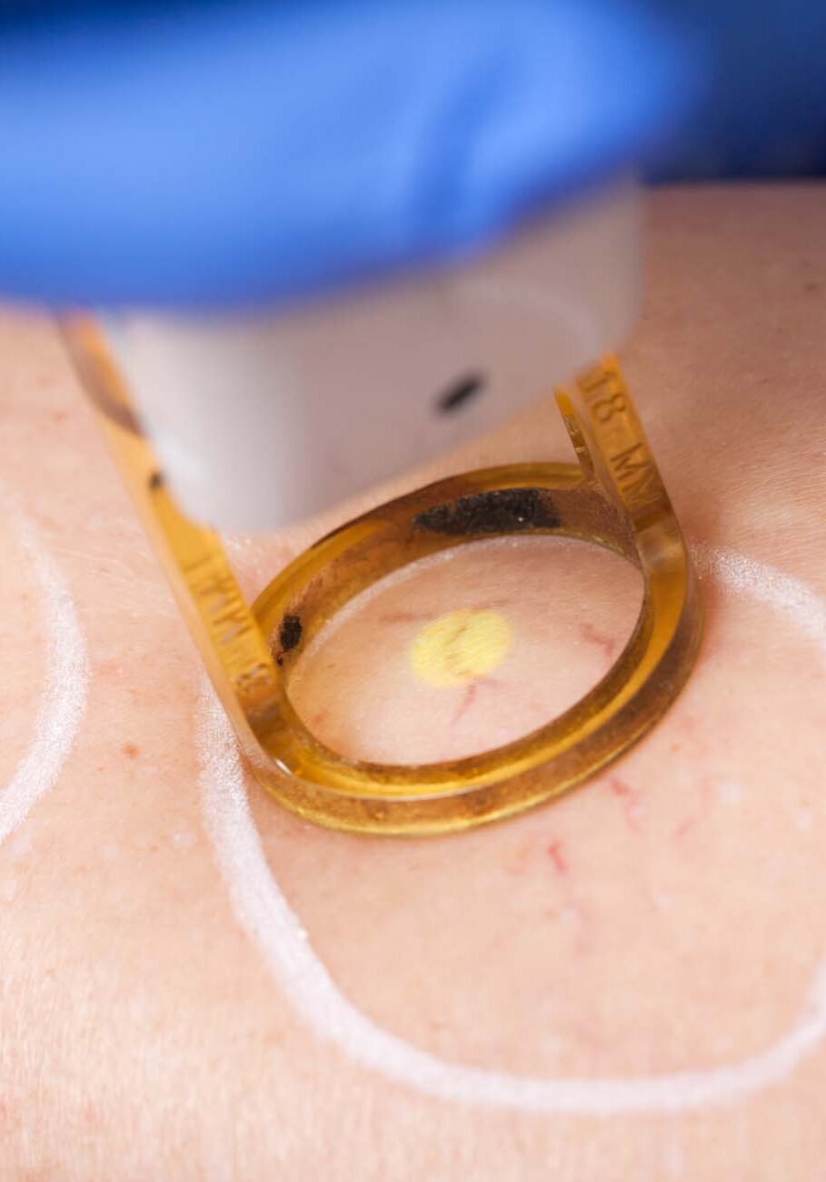 spider vein, medical laser Removal of spider veins on the leg by laser treatment.