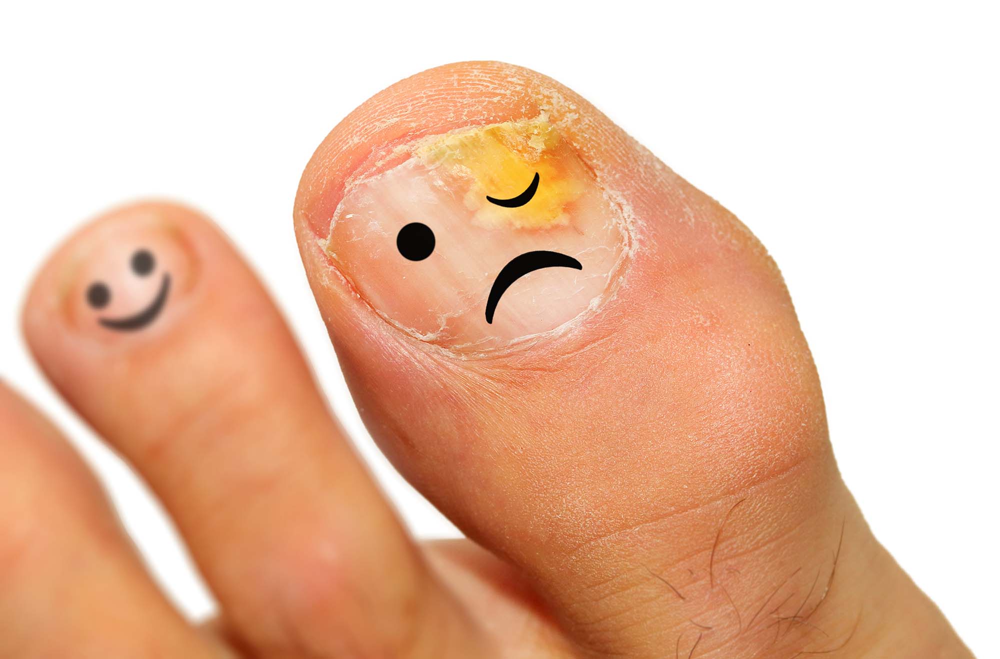 Onychomycosis fungal infection of the nail. It is the most common disease of the nails. It is an actual skin infection with the Trichophyton rubrum is the most common dermatophyte.