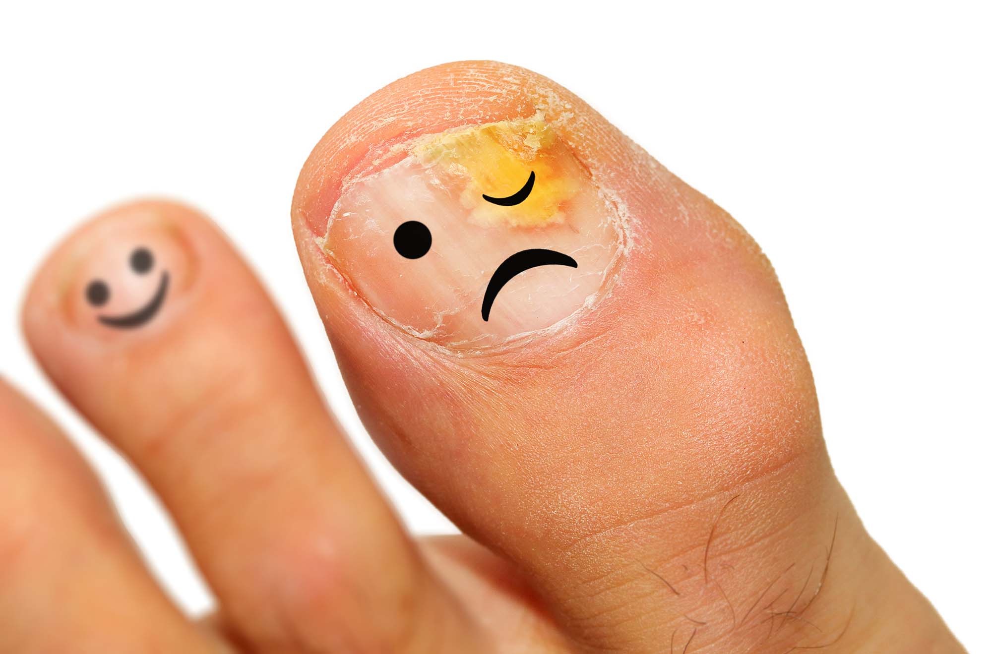 Onychomycosis fungal infection of the nail. It is the most common disease of the nails. It is an actual skin infection with the Trichophyton rubrum is the most common dermatophyte. Onychomycosis fungal infection of the nail. It is the most common disease of the nails. It is an actual skin infection with the Trichophyton rubrum is the most common dermatophyte.