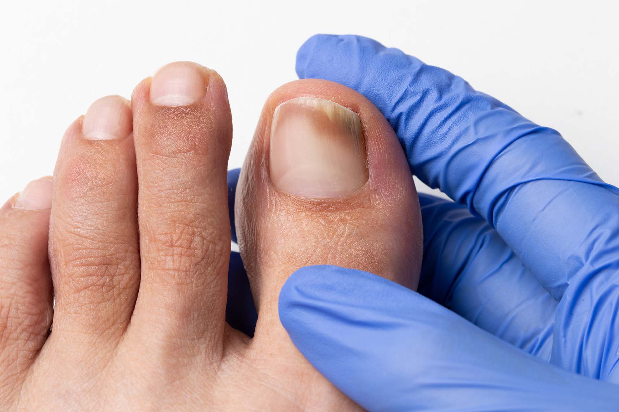 checking the damaged toenail Close-up image of the doctor who controls the left toe that suffers a fungus nail
