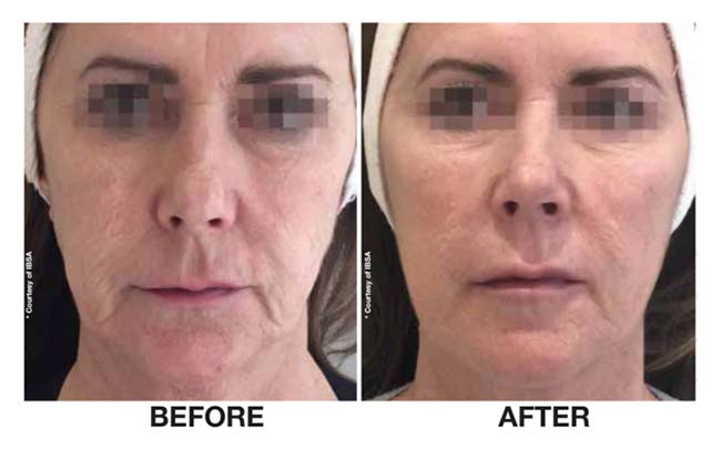 Botox woman fillers before and after