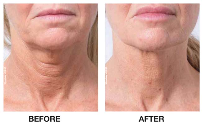 profhilo-before-after2 profhilo on woman fillers before and after